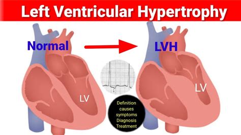 nice cks left ventricular hypertrophy